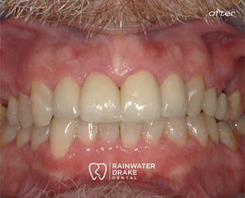 Cosmetic-Dental-Work-After-2 Full mouth restoration after with improved alignment and brighter smile at Rainwater Drake Dental