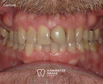 Cosmetic-Dental-Work-Before-1 Full mouth restoration after with improved alignment and brighter smile at Rainwater Drake Dental.