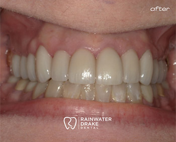 Cosmetic-Dentistry-Smile-After-2 Cosmetic dental work before/after at Rainwater Drake Dental, Little Rock AR