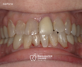 Cosmetic-Dentistry-Smile-Before-1 Cosmetic dental work before/after at Rainwater Drake Dental, Little Rock AR