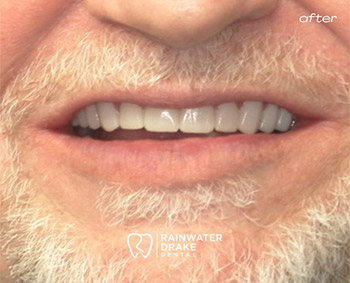 Dental-Implants-Smile-After-1 Dental implants and crowns after restoring missing teeth at Rainwater Drake Dental.