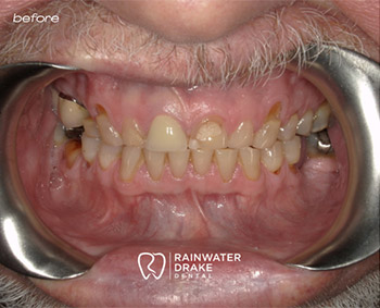 Dental-Implants-Smile-Before-1 Dental implants and crowns before restoring missing teeth at Rainwater Drake Dental.