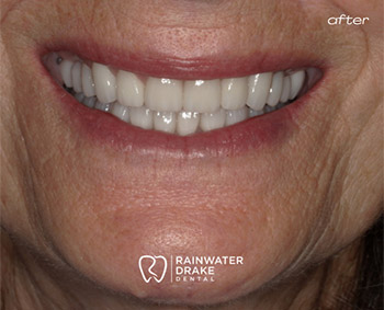 Dental-Restoration-Smile-After-1 Cosmetic dentistry after improving shape, color, and symmetry.