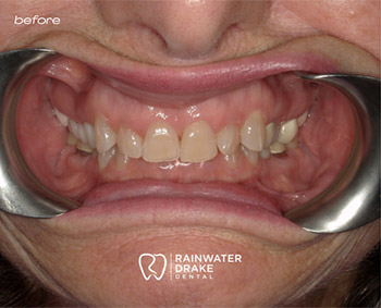 Dental-Restoration-Smile-Before-1 Cosmetic dentistry before improving shape, color, and symmetry.