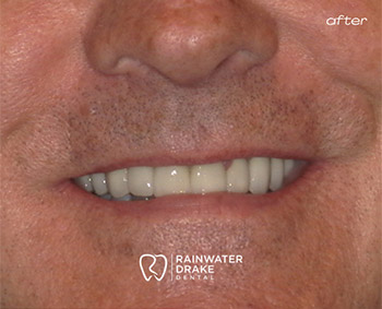 Full-Mouth-Restoration-After-1 Veneers after restoring worn and discolored teeth.