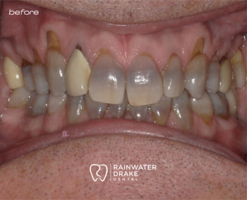 Full-Mouth-Restoration-Before-1 Veneers before restoring worn and discolored teeth.