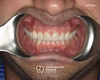 Smile-Transformation-Results-After-1 Teeth whitening after with a brighter, cleaner smile at Rainwater Drake Dental.