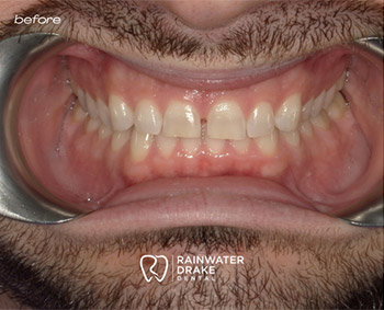 Smile-Transformation-Results-Before-1 Teeth whitening before with a brighter, cleaner smile at Hawkins Rainwater Drake Dental.