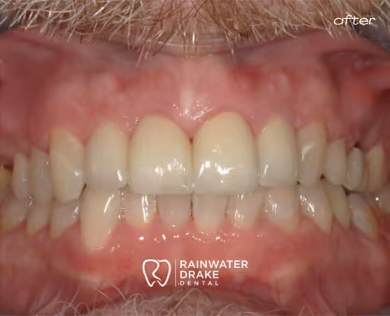 Brian-Veneers-after Brian-Veneers-after