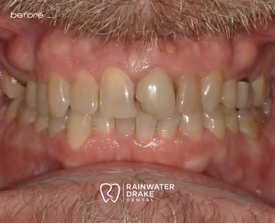 Brian-Veneers-before Brian-Veneers-before
