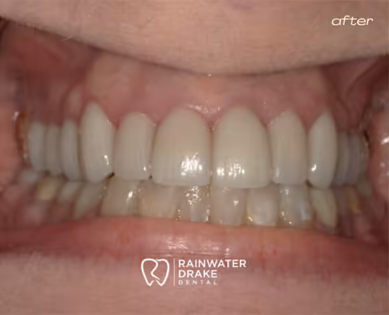 Kathy-Veneers-after Kathy-Veneers-after