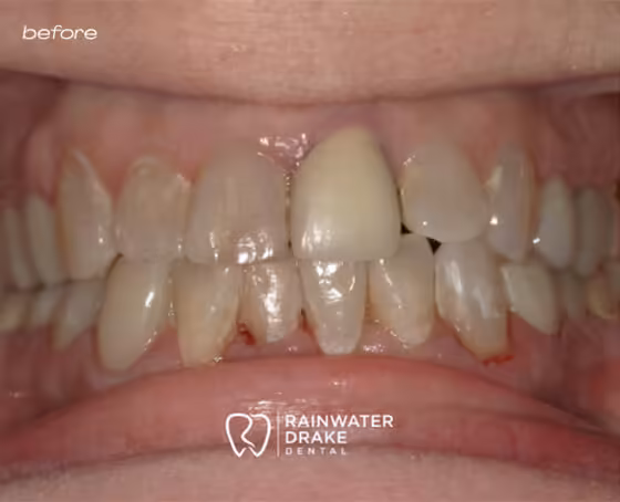 Kathy-Veneers-before Kathy-Veneers-before