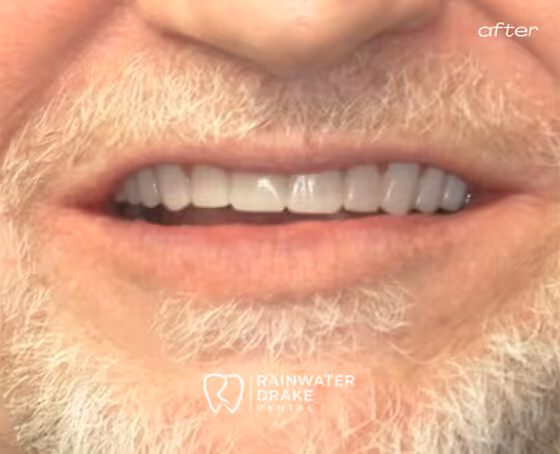 Leonard-Full-mouth-rehab-after Leonard-Full-mouth-rehab-after