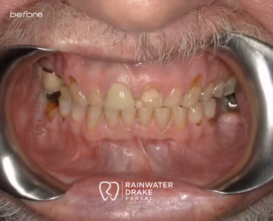 Leonard-Full-mouth-rehab-before Leonard-Full-mouth-rehab-before