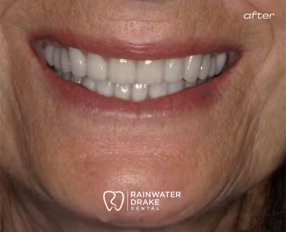 Linda-Full-mouth-rehab-after Linda-Full-mouth-rehab-after