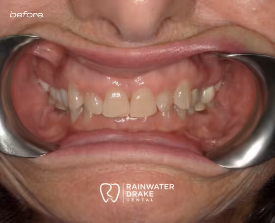 Linda-Full-mouth-rehab-before Linda-Full-mouth-rehab-before