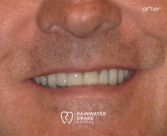 Mike-Veneers-after Mike-Veneers-after