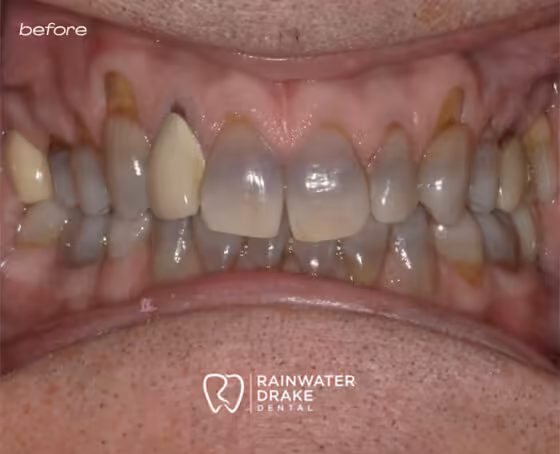 Mike-Veneers-before Mike-Veneers-before