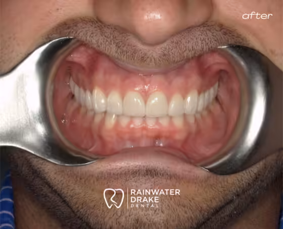 Robert-Veneers-after Robert-Veneers-after