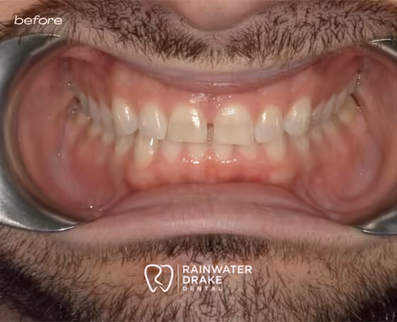 Robert-Veneers-before Robert-Veneers-before