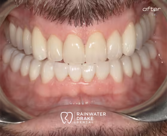 Ronny-Full-mouth-rehab-after Ronny-Full-mouth-rehab-after