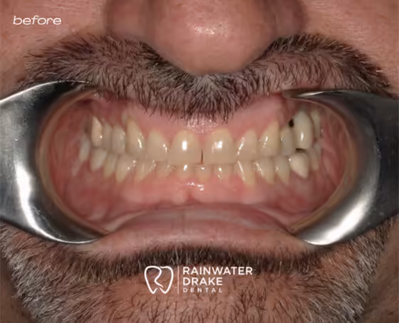 Ronny-Full-mouth-rehab-before Ronny-Full-mouth-rehab-before