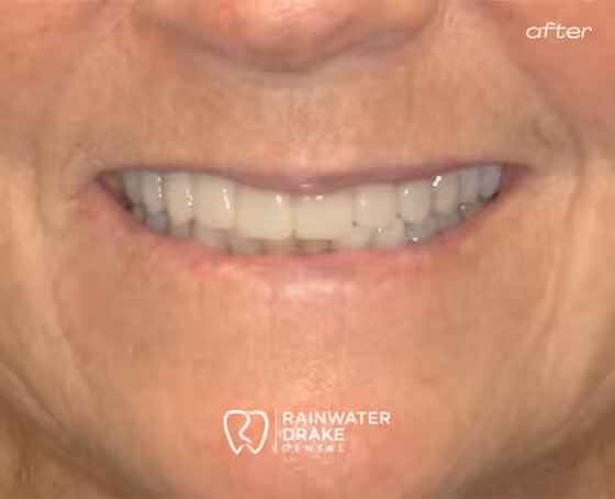 Sandra-Veneers-after Sandra-Veneers-after