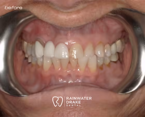 Sandra-Veneers-before Sandra-Veneers-before