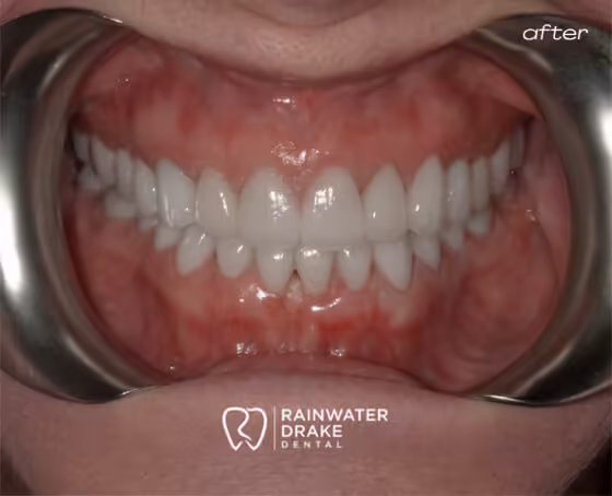 Shawna-Full-mouth-rehab-after Shawna-Full-mouth-rehab-after