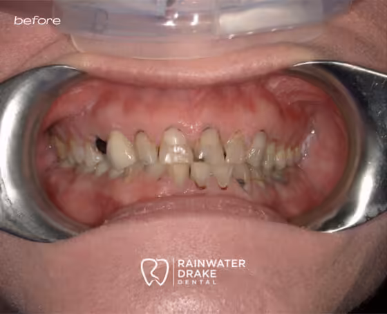 Shawna-Full-mouth-rehab-before Shawna-Full-mouth-rehab-before